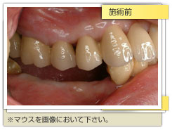 インプラント施術前