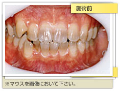 ホワイトニング施術前