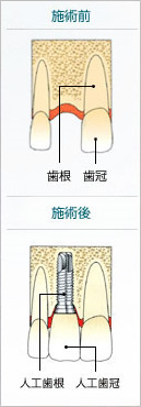 施術前と施術後のイメージ図